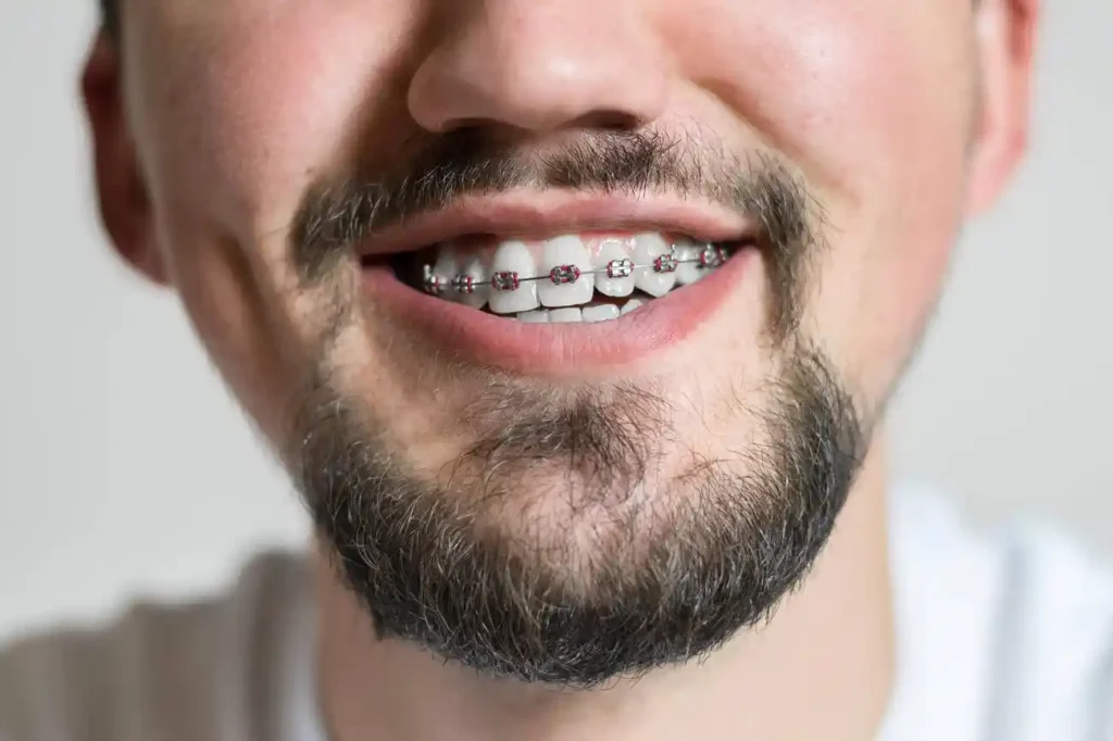 Can I Put on Braces at the Age of 35?