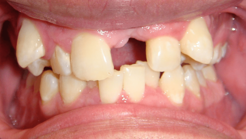 Look at this moderatly complex orthodontic case. She is missing a central incisor (middle tooth). She has major crowding. Should she just place an implant, that can never be moved? Or should she have a comprehensive plan from an orthodontist that puts her teeth in the best position to respect her lip esthetics, resolve her crowding, close her spaces and then finally establish where to place her implant? This is a typical example of how orthodontists are the architects of the mouth.