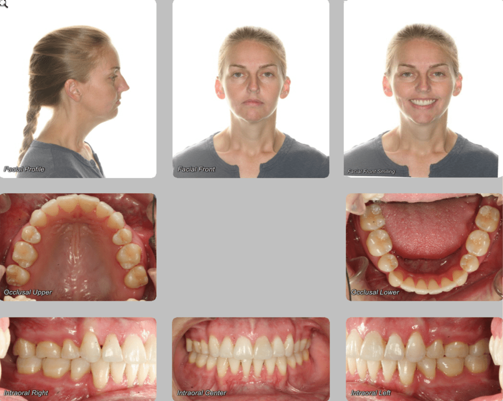 Amazing adult orthodontics done without surgery with traditional braces. no Invisaling, at minimal cost.