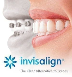 Why Invisalign is Faster than Braces
