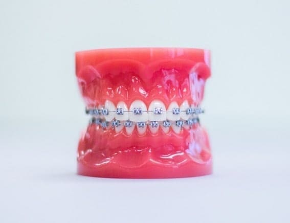 dental model with metal braces