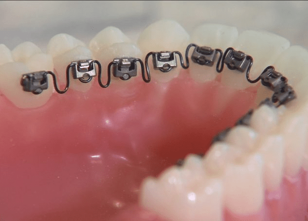 Picture of a dental model showing Inbrace lingual orthodontic braces.
