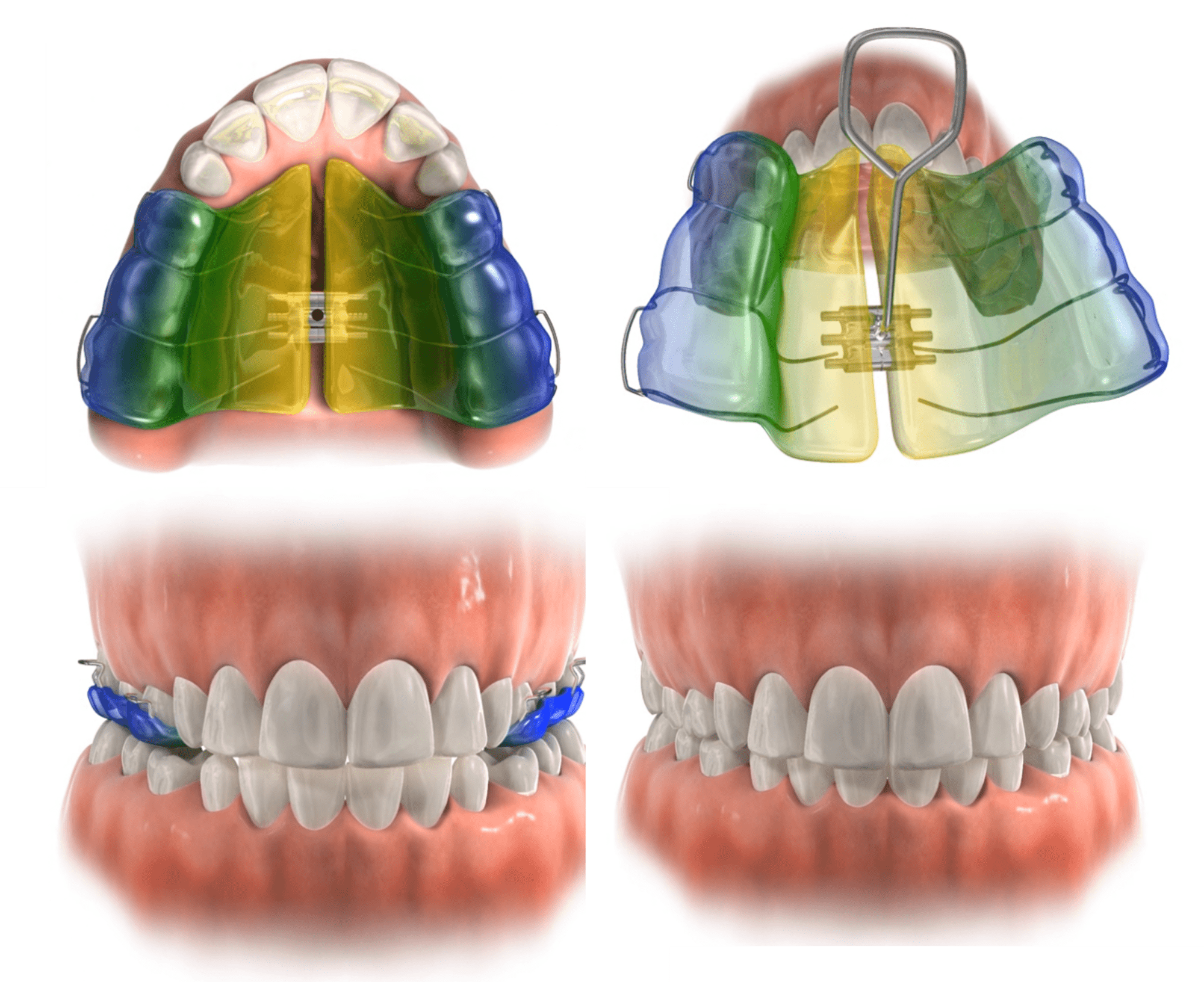 A removable expander can be used to widen the upper arch as illustrated here.