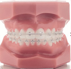 Frontal view of our self-ligating ceramic braces.