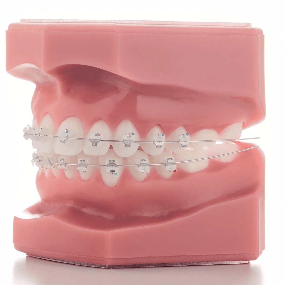 Self-ligating ceramic brackets offered at Limestone Hills Orthodontics in Austin TX,