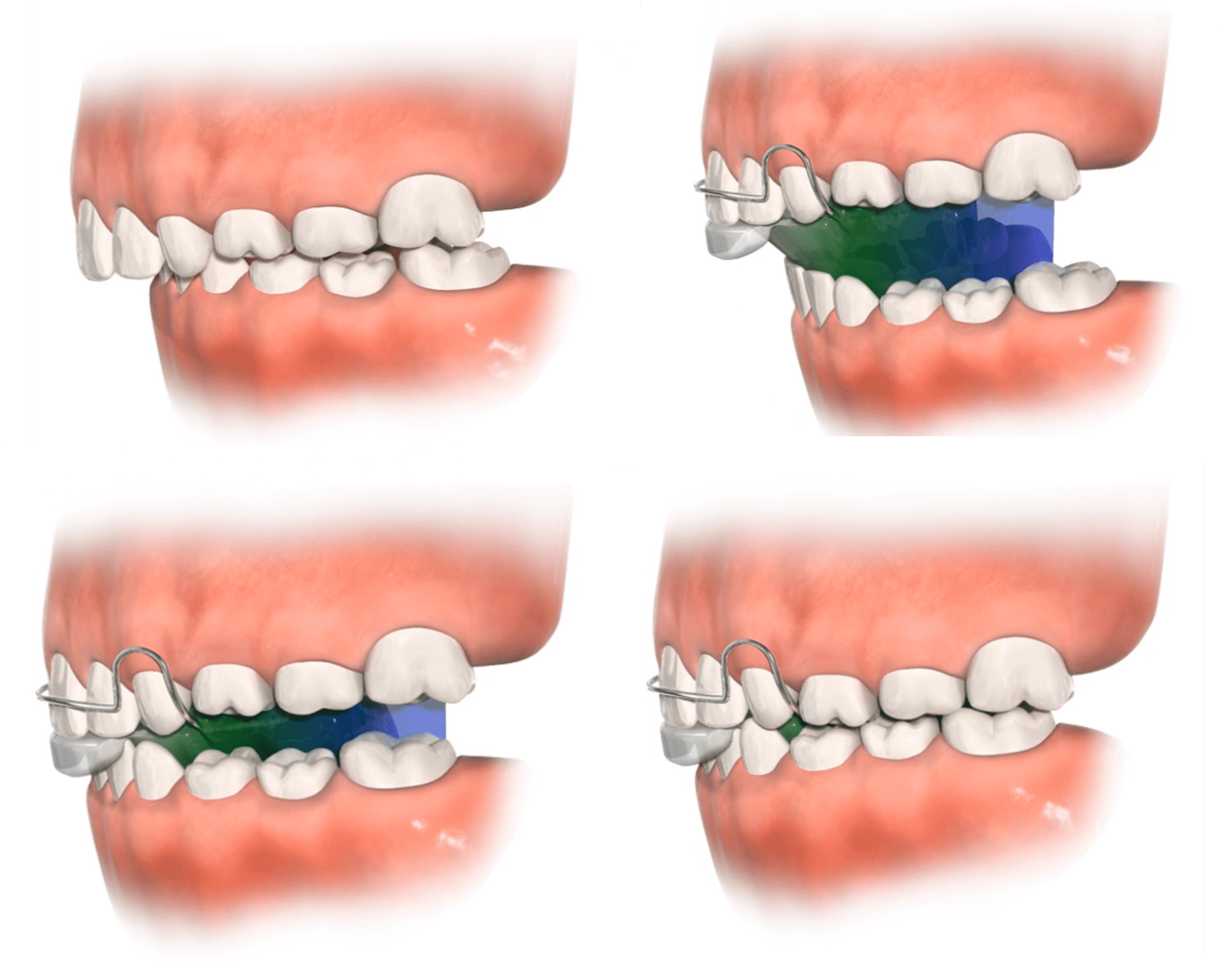 Activator to open the bite (Bionator to open) correcting a Class II malocclusion with deep overbite.